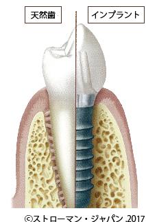 インプラント画像