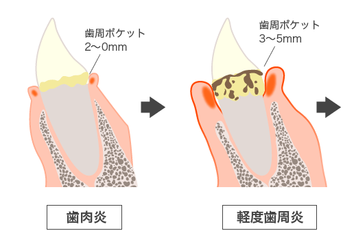 歯周病進行図解