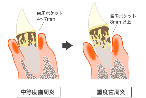 歯周病進行図解