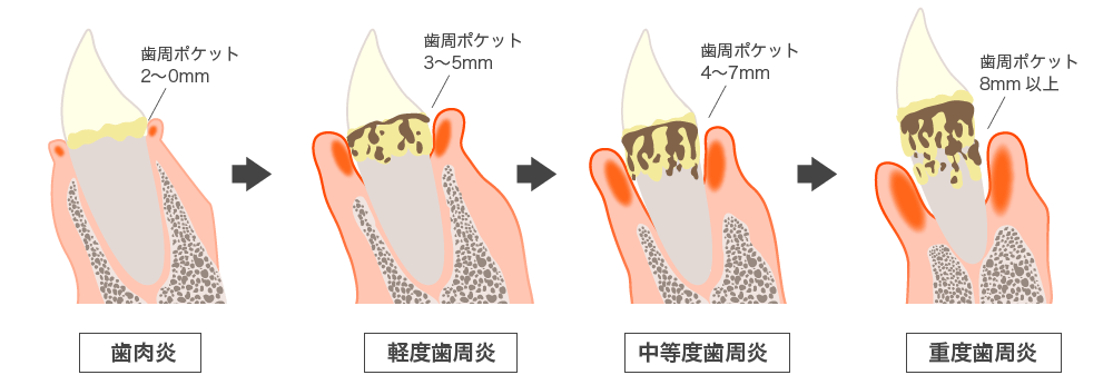 歯周病進行図解