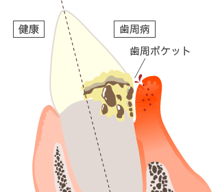 歯根の表面のプラークと歯垢（歯周病菌の温床）
