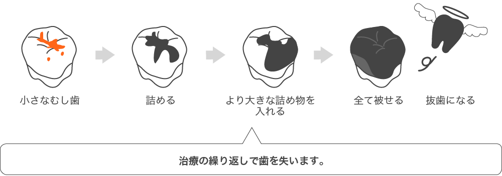 治療の繰り返しで歯を失います。